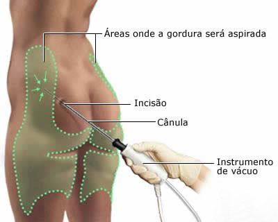 Lipossucção VS Lipoescultura