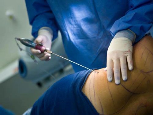 A lipoaspiração não é feita para emagrecer e perder peso