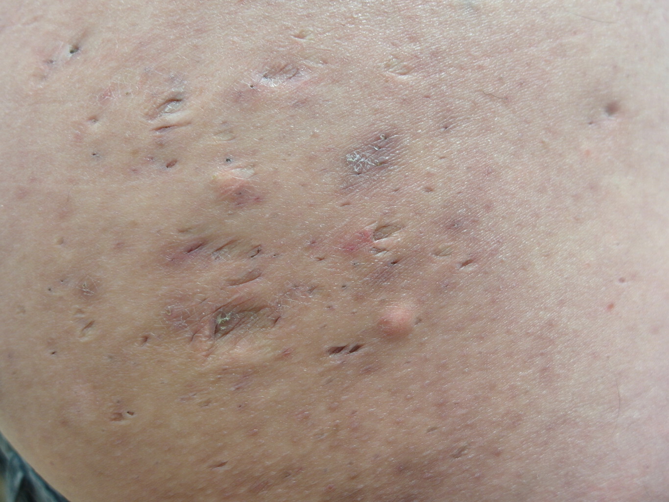 O que é a acne inversa e como se pode tratar